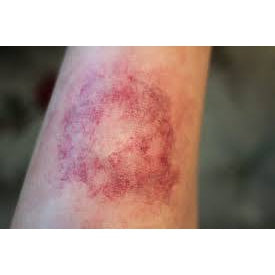 Why do women bruise so easily as especially compared to men - Pushing The Limits Podcast